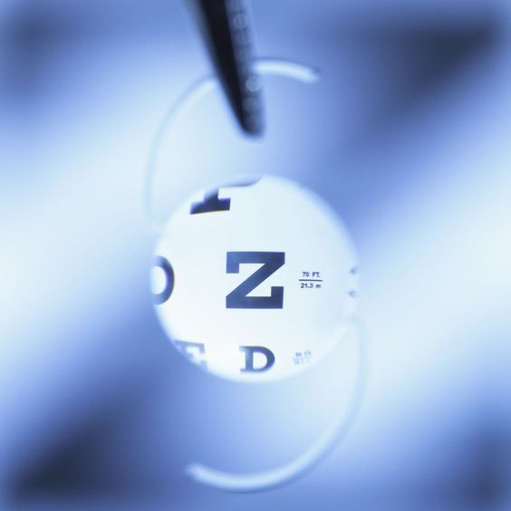 صورة توضح زراعة العدسة الذكية في إسطنبول لتصحيح النظر