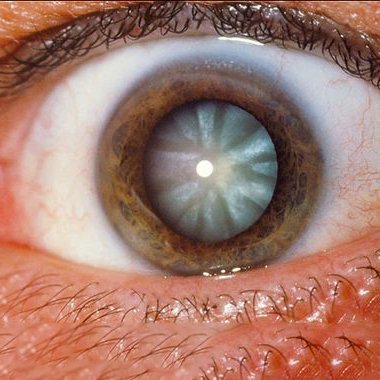 صورة لجراحة إزالة المياه البيضاء في إحدى العيادات المتخصصة في إسطنبول