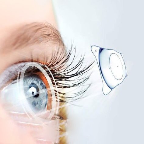 صورة توضح كيفية إجراء عملية زراعة العدسات في إسطنبول