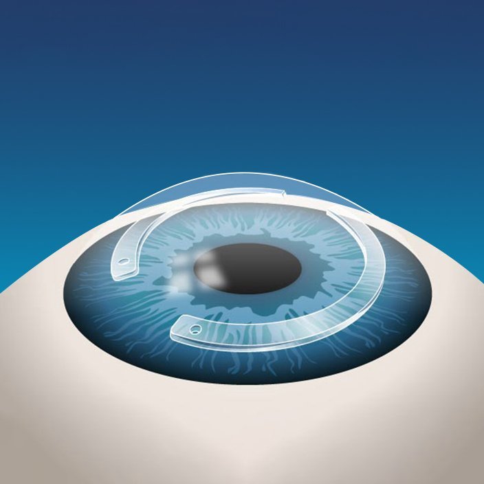 صورة لحلقات السيليكون المستخدمة في علاج القرنية المخروطية في إسطنبول