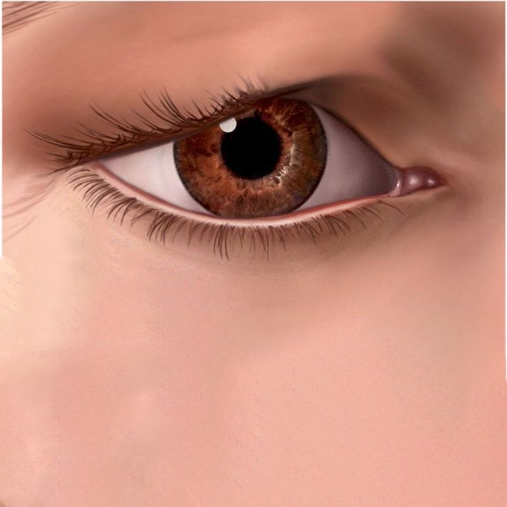 صورة توضح نتائج عملية علاج إنسدال الجفون لعلاج تدلي الجفن العلوي في إسطنبول