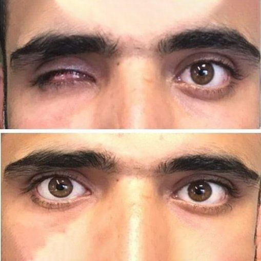 تركيب بروتيز العين - عين صناعية في إسطنبول